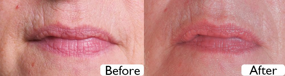 CurrentBody Skin RF Radio Frequency Skin Tightening Device before and after image