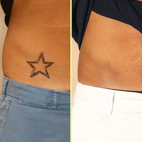 NAAMA Studios laser tatto removal before and after image
