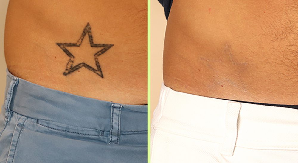 NAAMA Studios laser tatto removal before and after image