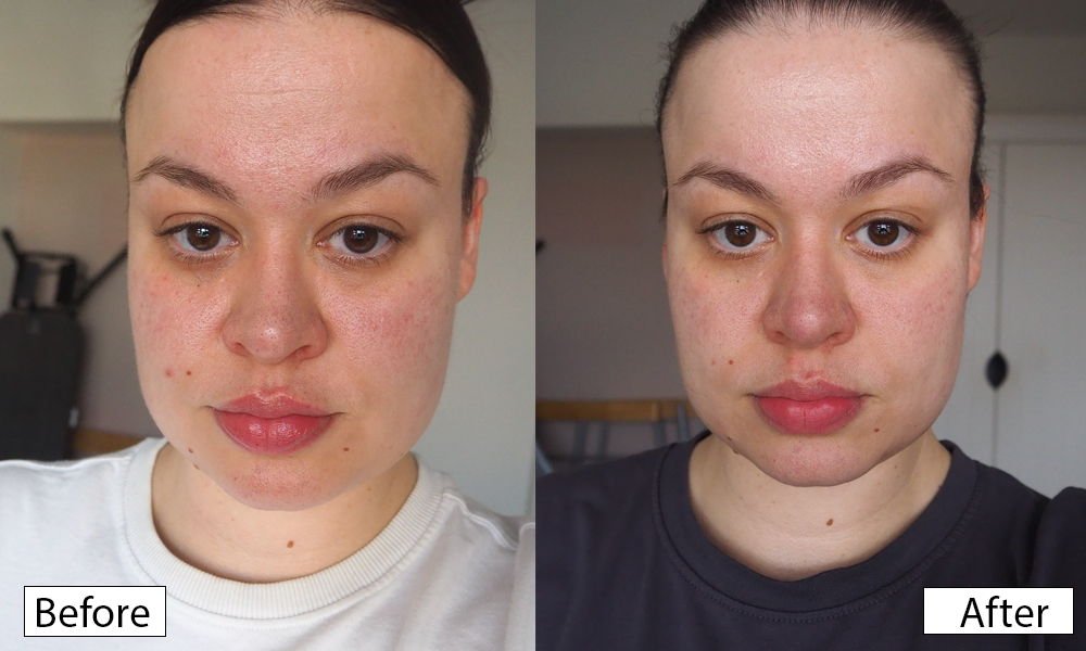 Project E Beauty LumaLux Face Pro before and after photo image